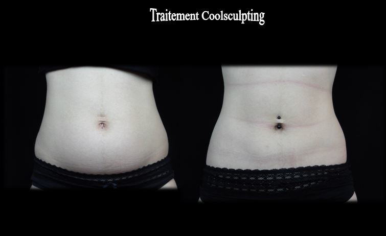 Ventre traitement coolsculpting