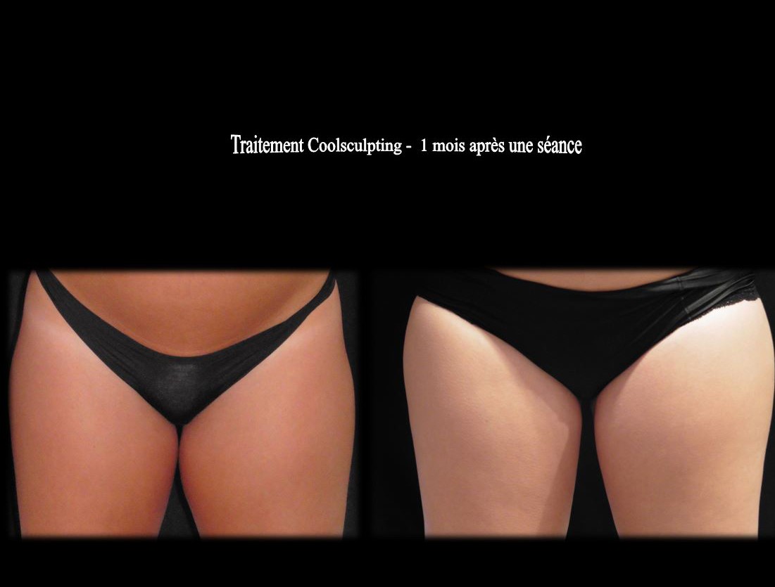 interieur des cuisses Coolsculpting