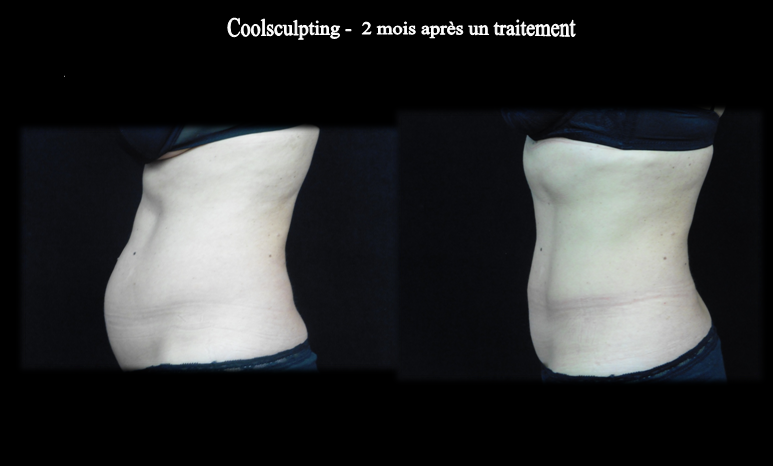 Ventre traitement coolsculpting